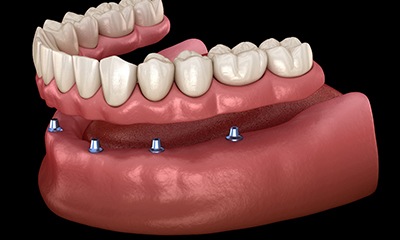 Image of an implant-retained denture for lower teeth.