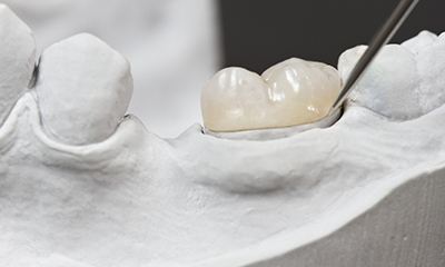 Model of tooth with onlay
