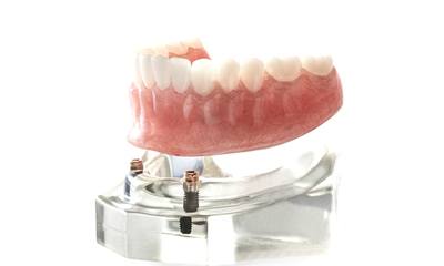 Implant-retained dentures in Wethersfield