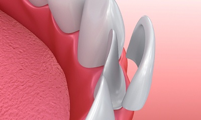 computer model of porcelain veneers fitting over teeth