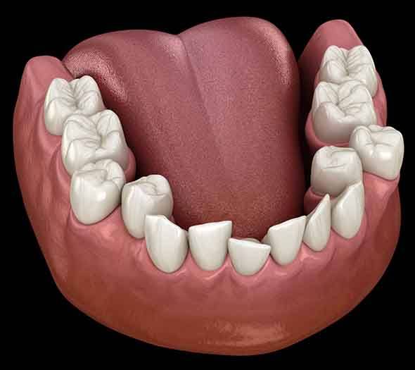 Illustration of crowded teeth