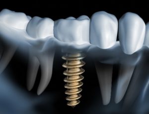 Benefits of Computer-Guided Dental Implant Surgery